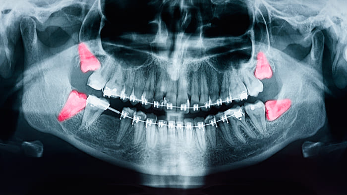 cirugia oral