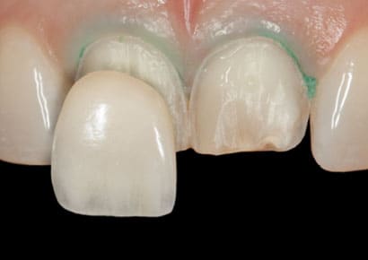 Estética dental